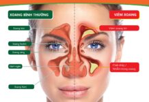 Ăn uống gì giảm chứng viêm xoang